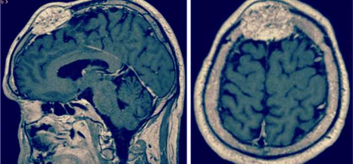Менингиома , доброкачественная опухоль головного мозга