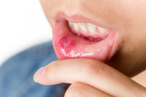 лекарство принимать от стоматита во рту у детей и взрослых