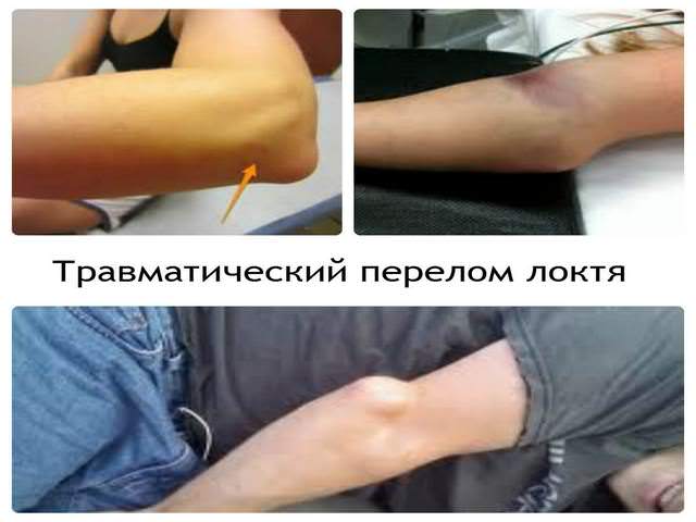 Травма средней части руки