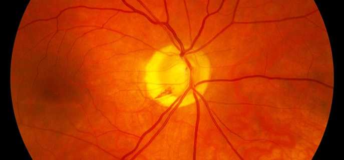 Симптомы и причины атрофии зрительного нерва
