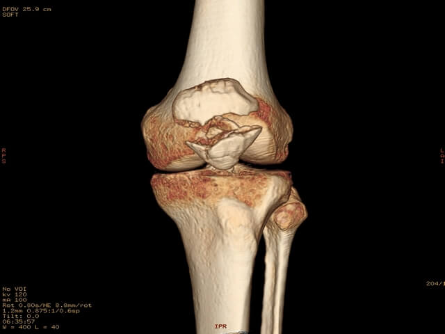 Томография коленной части ноги
