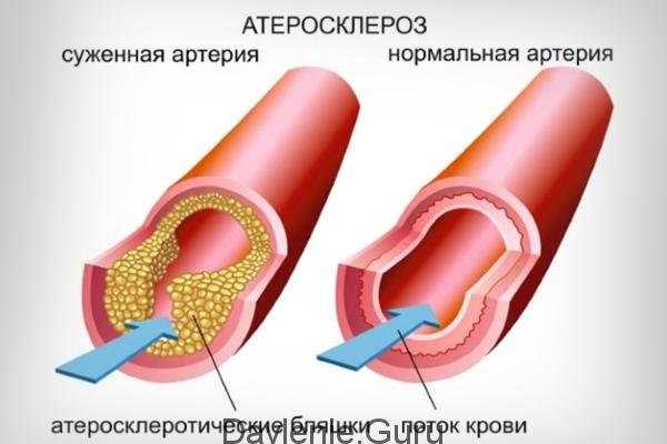 Атеросклерозе сосудов
