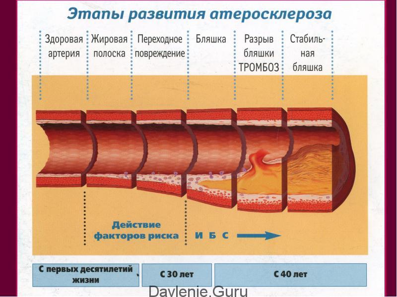 Атеросклеротическая бляшка