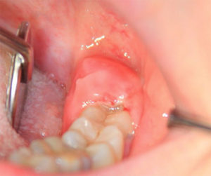 Каким должен быть уход за полостью рта после удаления зуба