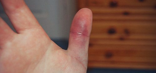 Вывих пальца руки — симптомы и лечение