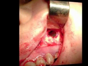 Симптомы и лечение радикулярной кисты зуба верхней челюсти