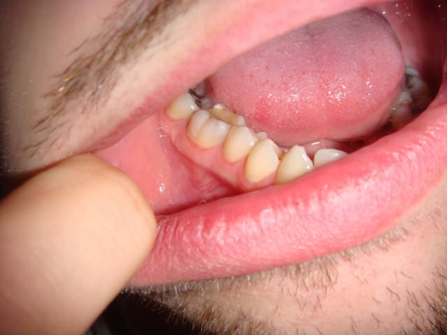 Заболевание слизистой рта