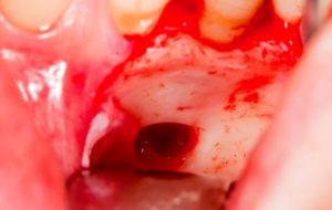  проводится цистэктомия зуба