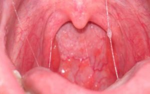 Основные симптомы и лечение стоматита в горле