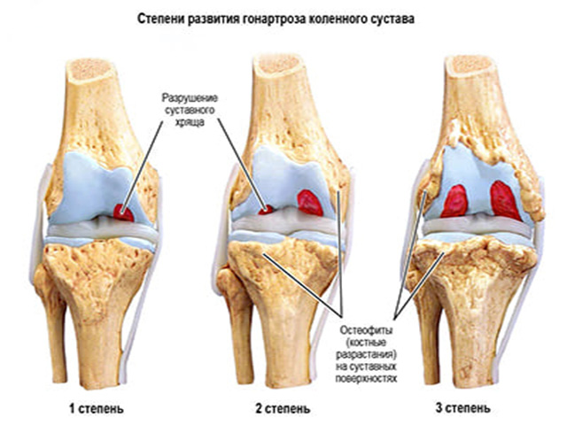 Что такое гонартроз коленного сустава 1 степени и как его лечить