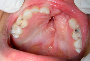лечение пульпита молочных зубов 