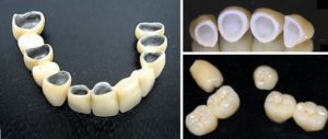 Какие бывают разновидности коронок на зубы