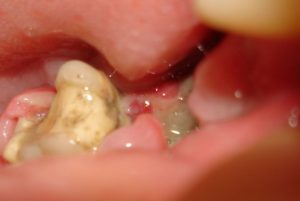Какими могут быть осложнения после удаления зуба мудрости на нижней челюсти