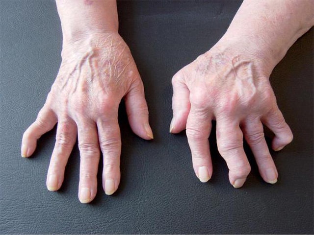 Симптомы и методы лечения ревматоидного артрита пальцев рук