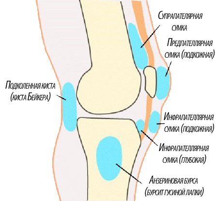 Виды бурсита коленного сустава
