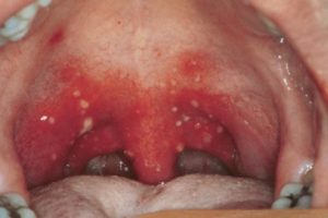симптомы и лечение стоматита в горле
