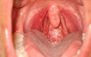 лечение стоматита в горле