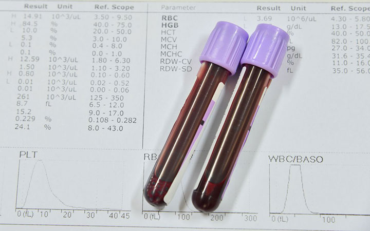 Чтобы узнать свой уровень гемоглобина необходимо сдать анализ крови он поможет получить верный результат
