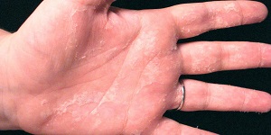 Шелушение кожи рук при дисгидрозе