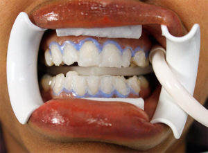Как проводится химическое отбеливание зубов