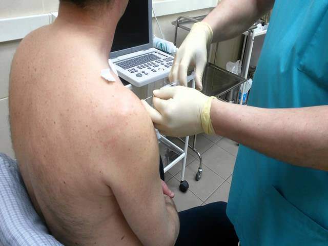 Лечение артроза плечевого сустава