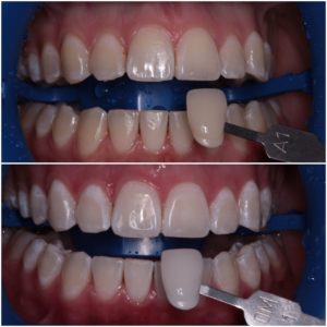 Вредно ли отбеливание зубов для здоровья
