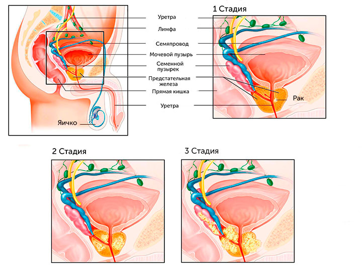 Стадии аденомы простаты
