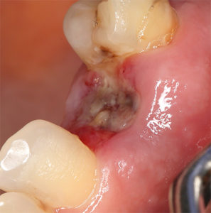 альвеолит после удаления зуба и его лечение