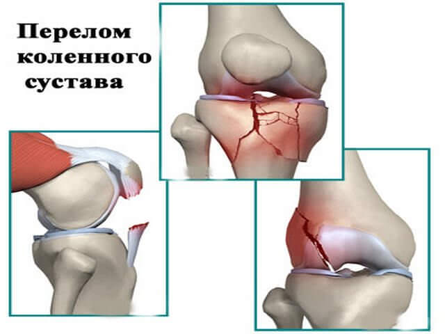 Повреждение коленной чашечки ноги