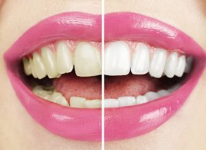 Вредно ли отбеливание зубов