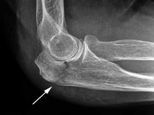Рентгеновский снимок руки