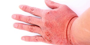 Контактный дерматит на руке