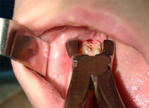 осложнения после удаления зуба мудрости на нижней челюсти