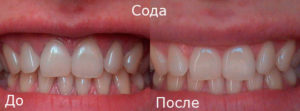 Процесс отбеливания зубов содой